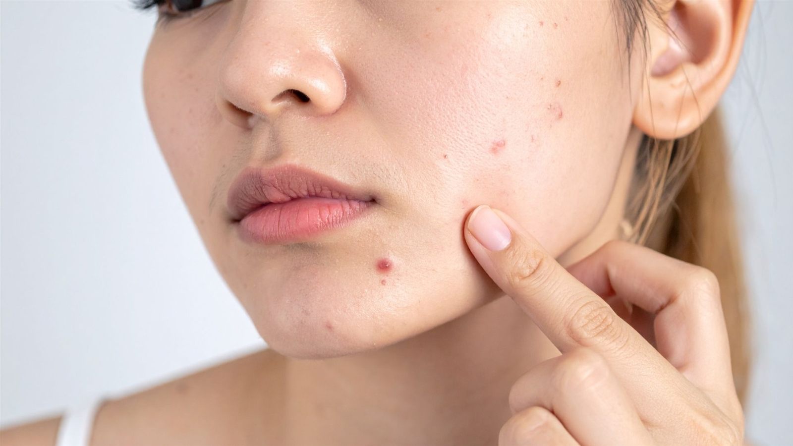 Acne treatment consultation and targeted care